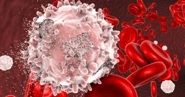 خلايا مناعية قد تمهد الطريق لسرطان الدم عبر نخاع العظام 