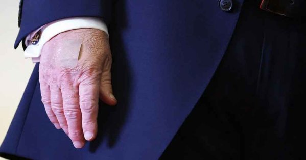 البيت الأبيض يفسّر ظهور كدمات على يد دونالد ترامب بالمصافحات المتكررة واستخدام الأسبرين 