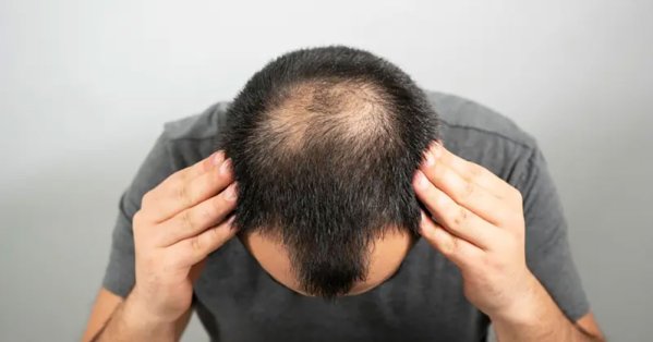 اكتشاف بالصدفة قد يغيّر علاج الصلع.. سكر بسيط يعيد إنبات الشعر 