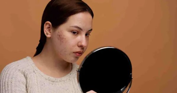 حب الشباب في الشتاء.. لماذا يكثر وكيف نتخلص منه؟ 